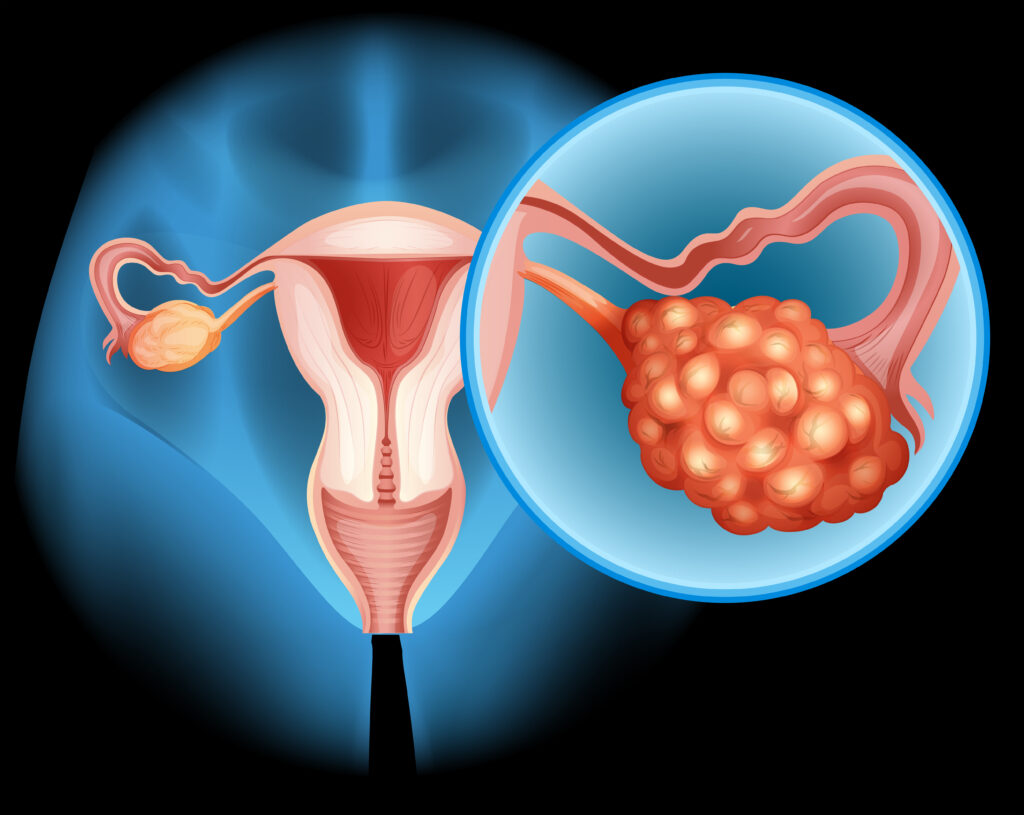 Pregnancy with Ovarian Cyst